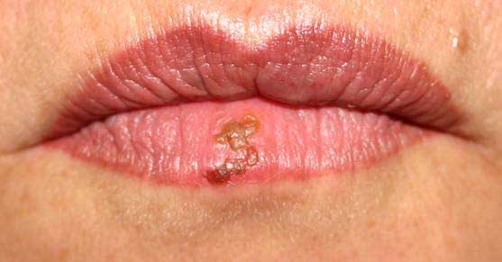 Munnsår og herpes