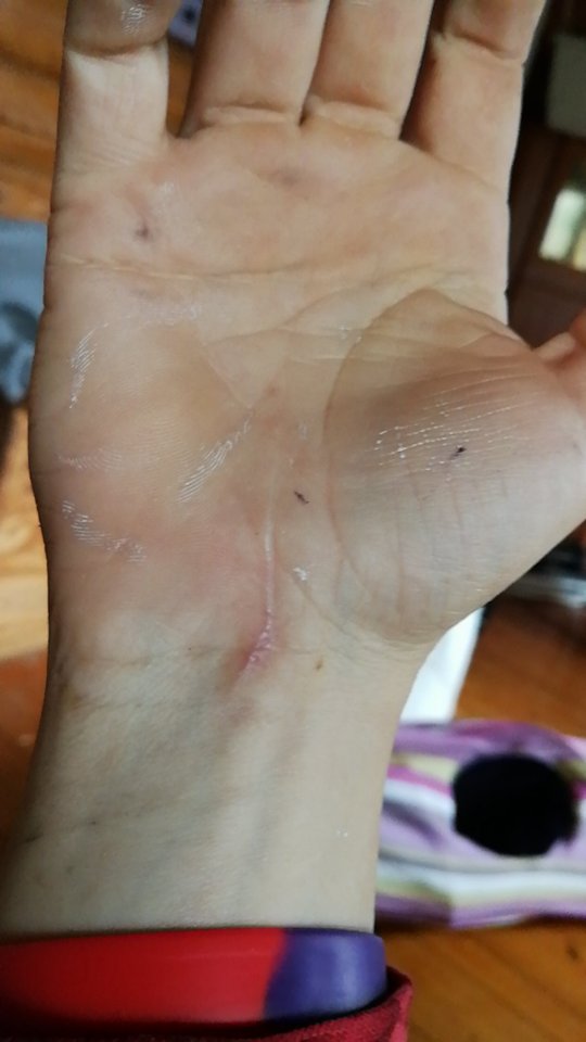 Arrbehandling – resultat