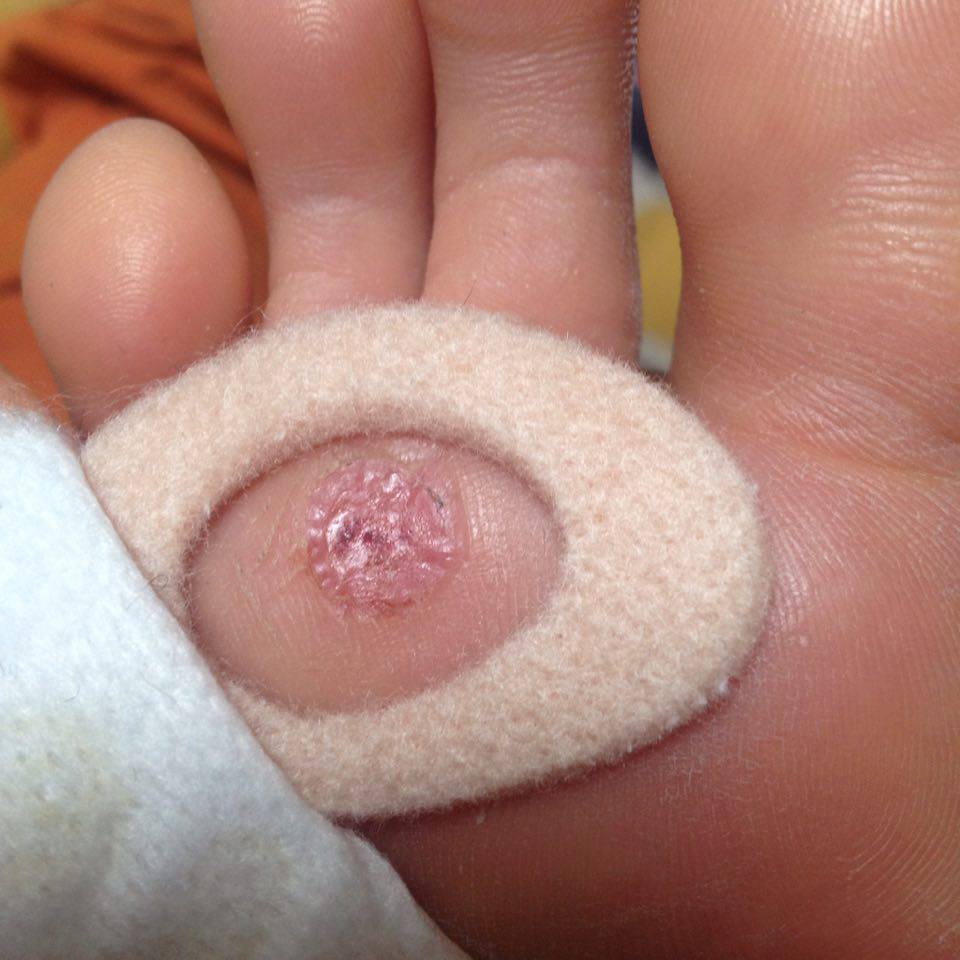 Vortebehandling – 2. behandling