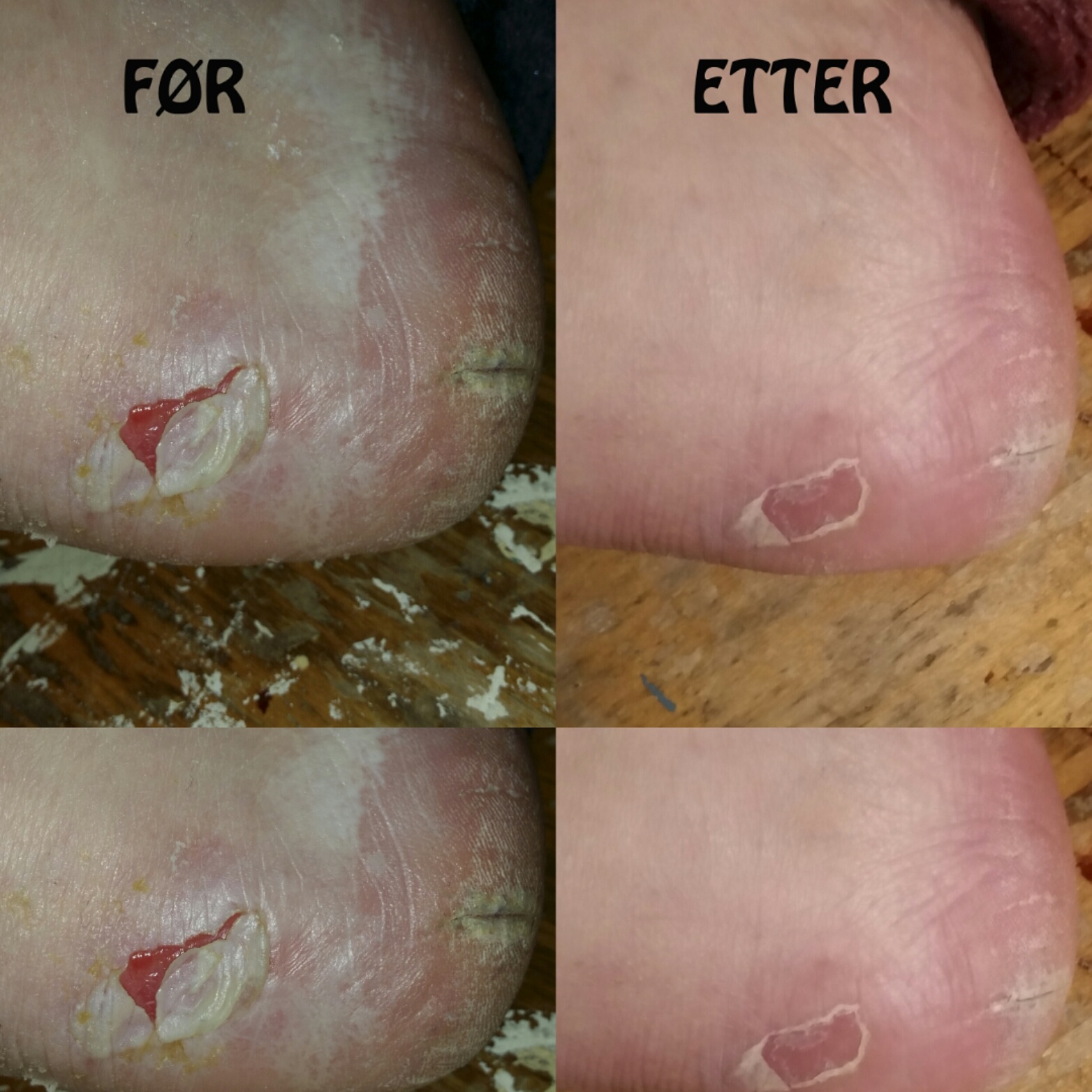 Vortebehandling – resultat